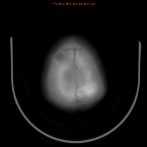 File:Neurofibromatosis type 2 (Radiopaedia 8953-9732 Axial bone window 30).jpg