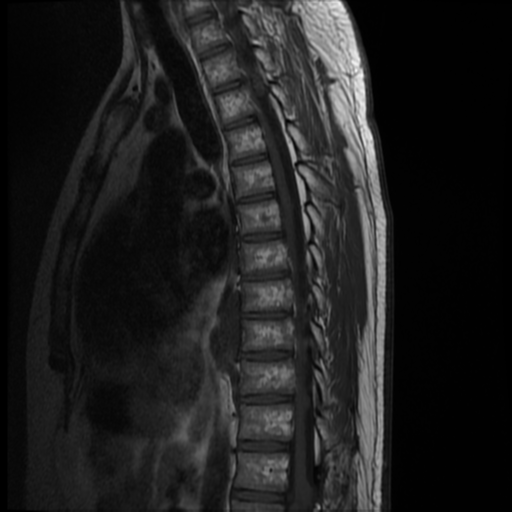File:Neurofibromatosis type 2 (spinal manifestations) (Radiopaedia 53943-60070 D 8).png