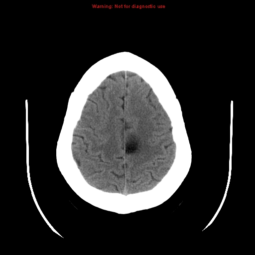 File:Neuroglial cyst (Radiopaedia 10713-11185 Axial non-contrast 7).jpg