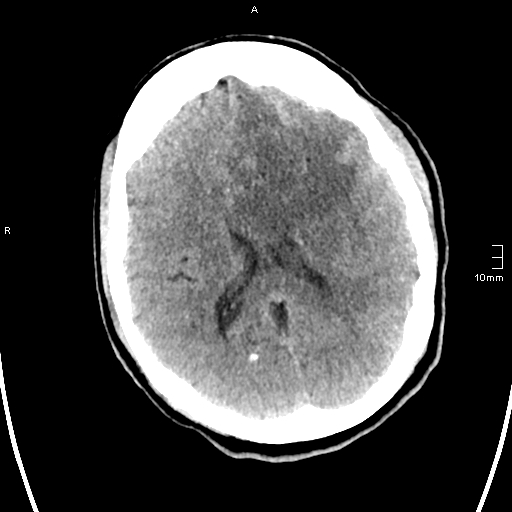 File:Neurotoxoplasmosis - concentric target sign (Radiopaedia 70644-80783 Axial non-contrast 22).jpg