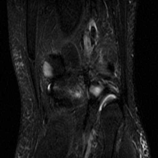 File:Non-displaced patella fracture (Radiopaedia 15932-15582 Coronal STIR 19).jpg