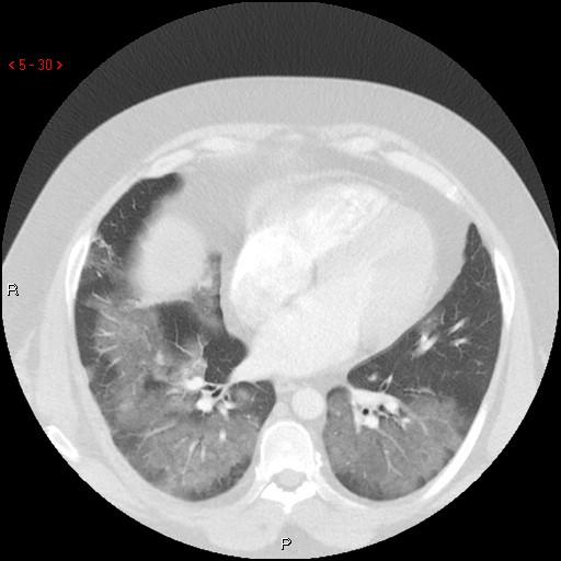 File:Non-specific interstitial pneumonitis (Radiopaedia 27044-27222 Axial lung window 21).jpg