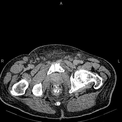 Non Hodgkin lymphoma in a patient with ankylosing spondylitis (Radiopaedia 84323-99621 Axial C+ delayed 84).jpg