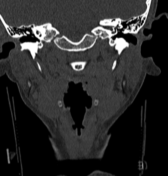 File:Normal CT cervical spine - 12-year-old (Radiopaedia 55352-61775 Coronal bone window 22).jpg