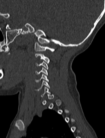 File:Normal CT cervical spine - pediatric (Radiopaedia 52549-58462 Sagittal bone window 175).jpg