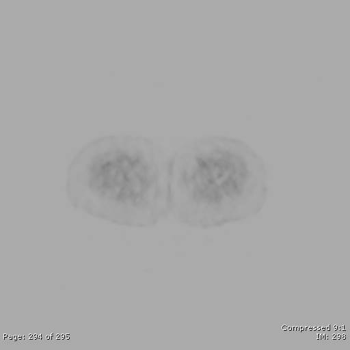 File:Normal F-18 FDG PET-CT (Radiopaedia 77382-89510 C 294).jpg