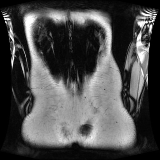 Normal MRI abdomen in pregnancy (Radiopaedia 88001-104541 N 124).jpg