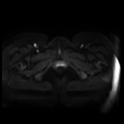 Normal MRI abdomen in pregnancy (Radiopaedia 88005-104548 Axial DWI 41).jpg