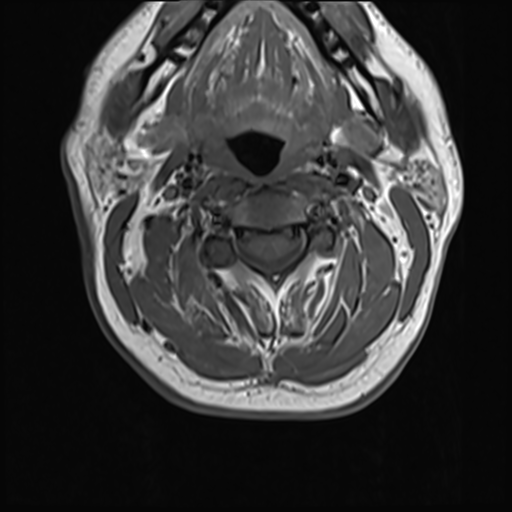 File:Normal MRI cervical spine (infection protocol) (Radiopaedia 53916-60039 Axial 18).png