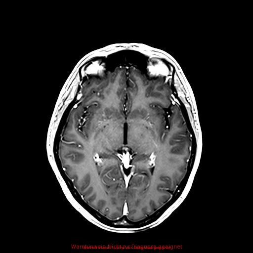 Normal adult brain MRI (non-enhanced and contrast-enhanced) (Radiopaedia 75262-86379 Axial T1 C+ 100).jpg