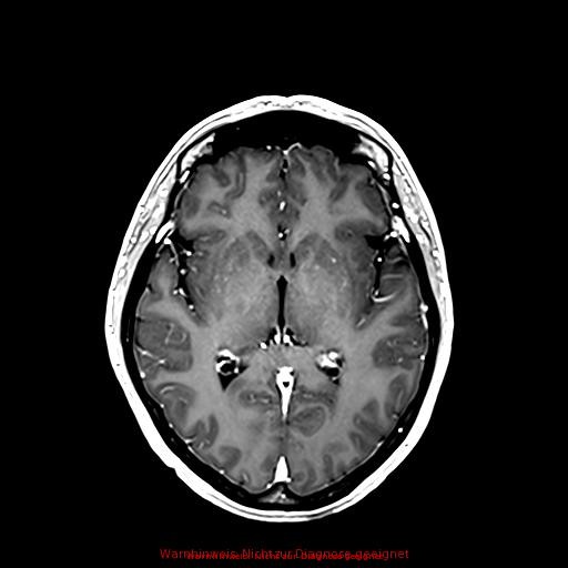 Normal adult brain MRI (non-enhanced and contrast-enhanced) (Radiopaedia 75262-86379 Axial T1 C+ 104).jpg
