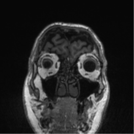 Normal brain MRI (non-focal epilepsy protocol) (Radiopaedia 53917-60040 Coronal T1 58).png