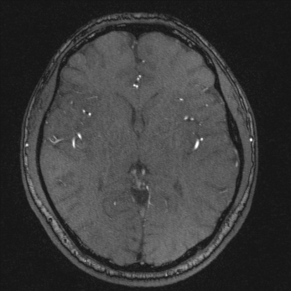 Normal brain MRI including MRA (Radiopaedia 48748-53763 Axial MRA 115).jpg
