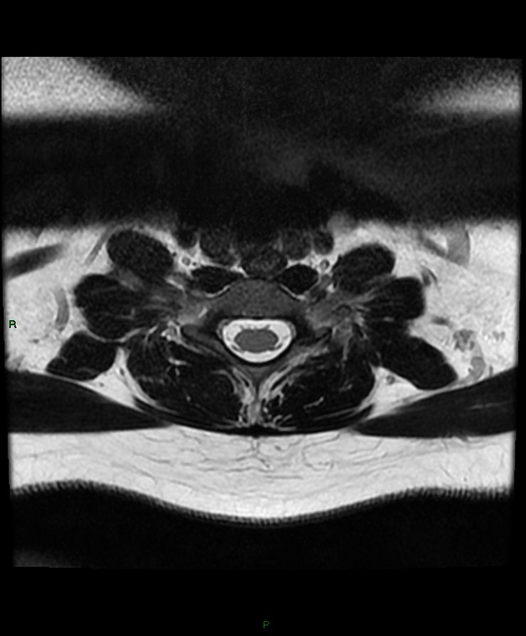 Normal cervical spine MRI (Radiopaedia 80146-93454 Axial T2 80).jpg