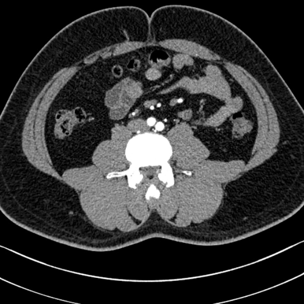 Normal kidneys on 4-phase CT study (Radiopaedia 25889-26038 B 78).jpg