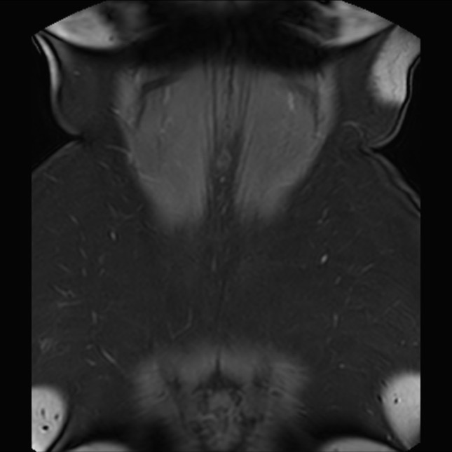 Normal liver MRI with Gadolinium (Radiopaedia 58913-66163 P 81).jpg