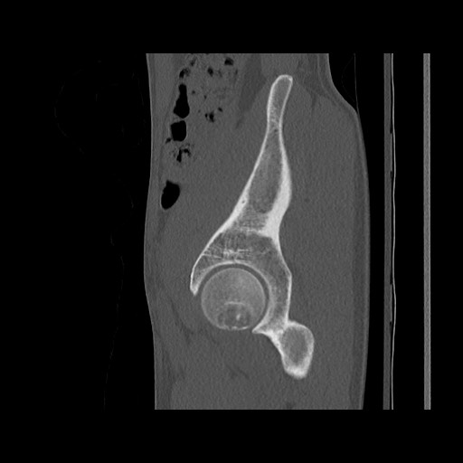 Normal pelvis (Radiopaedia 51473-57238 Sagittal bone window 39).jpg