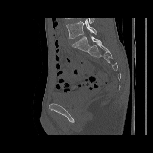 Normal pelvis (Radiopaedia 51473-57238 Sagittal bone window 83).jpg