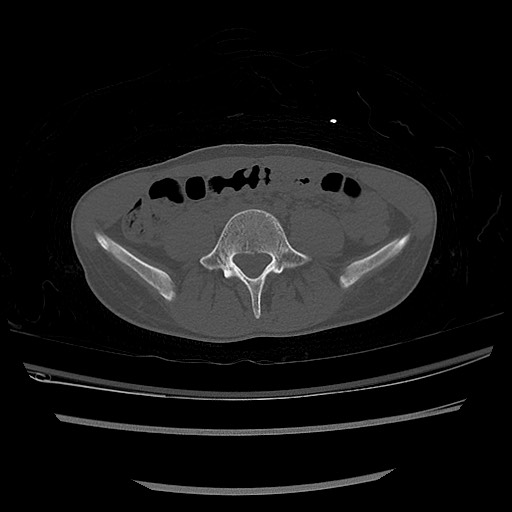 Normal pelvis CT (Radiopaedia 51471-57236 Axial bone window 8).jpg
