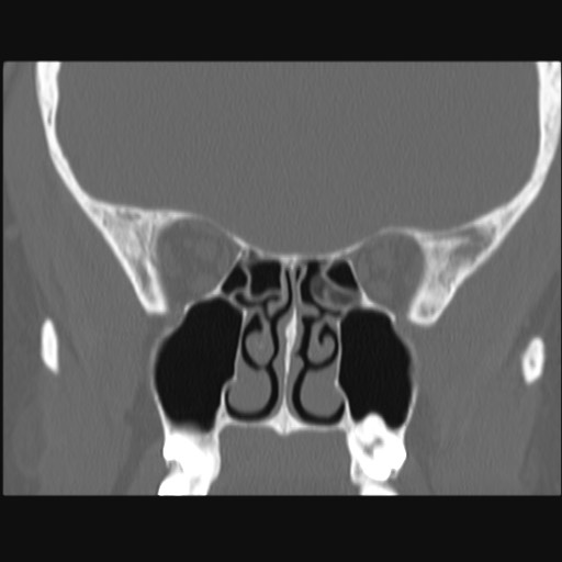 Normal sinus CT (annotated) (Radiopaedia 78917-91810 Coronal bone window 34).jpg