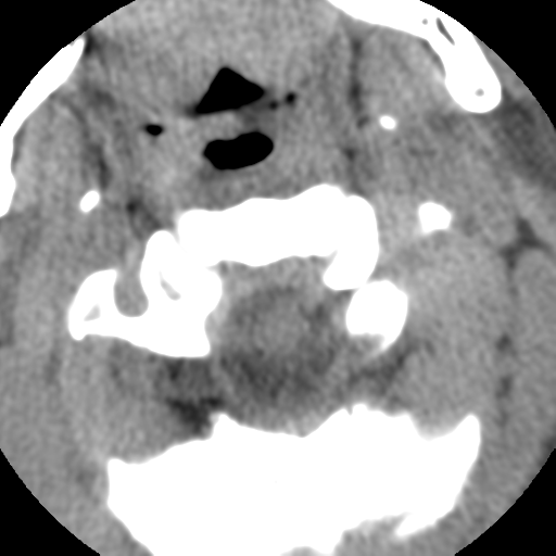 Normal trauma cervical spine (Radiopaedia 41017-43760 Axial non-contrast 15).png
