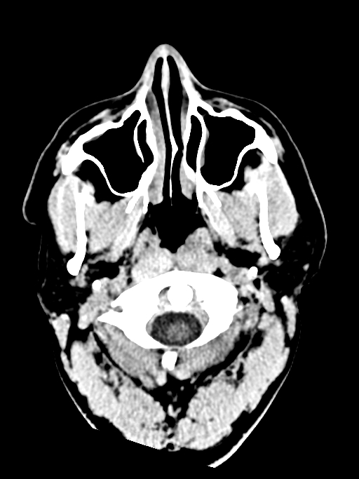 Normal trauma protocol brain and C-spine CT (Radiopaedia 83302-97709 Axial non-contrast 70).jpg