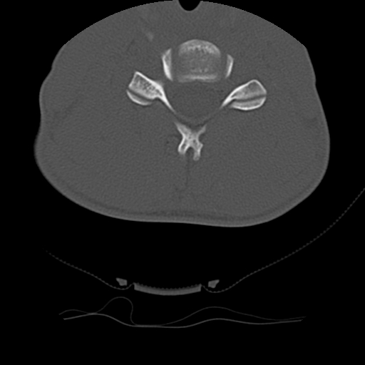 File:Normal trauma spine imaging (age 16) (Radiopaedia 45335-49358 Axial bone window 50).jpg