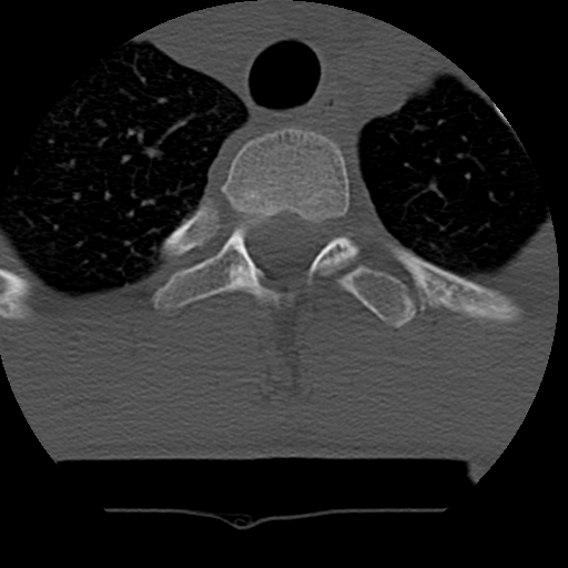 Normal trauma spine imaging (age 16) (Radiopaedia 45335-49358 Axial bone window 85).jpg