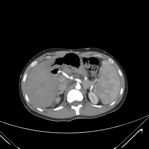 File:Nutmeg liver- Budd-Chiari syndrome (Radiopaedia 46234-50635 A 25).png
