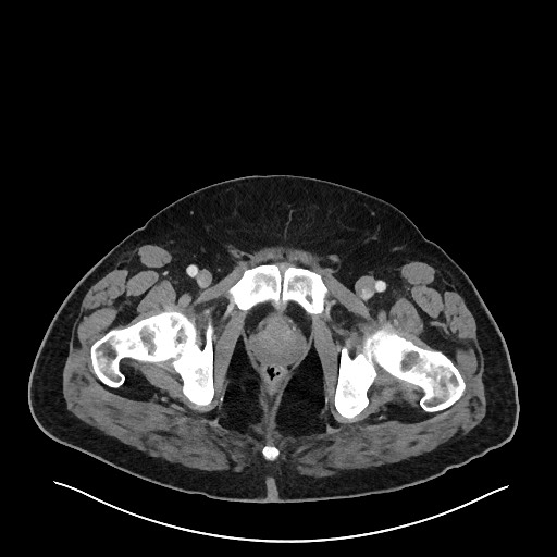Obstructing sigmoid adenocarcinoma (Radiopaedia 58465-65619 A 161).jpg