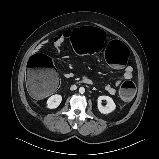 Obstructing sigmoid adenocarcinoma (Radiopaedia 58465-65619 A 77).jpg