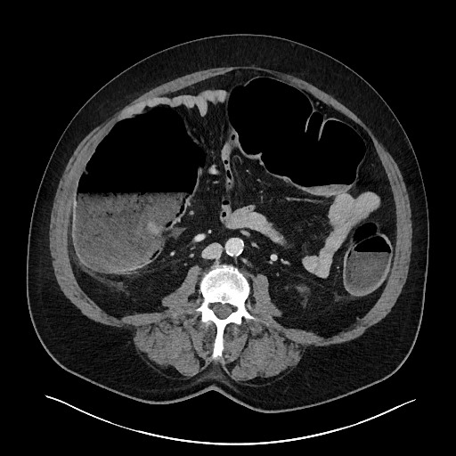 File:Obstructing sigmoid adenocarcinoma (Radiopaedia 58465-65619 A 89).jpg