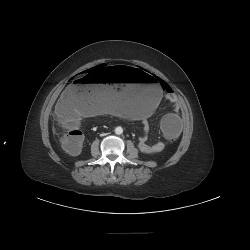 Obstructive distal colonic adenocarcinoma causing cecal perforation (Radiopaedia 86830-102989 A 108).jpg