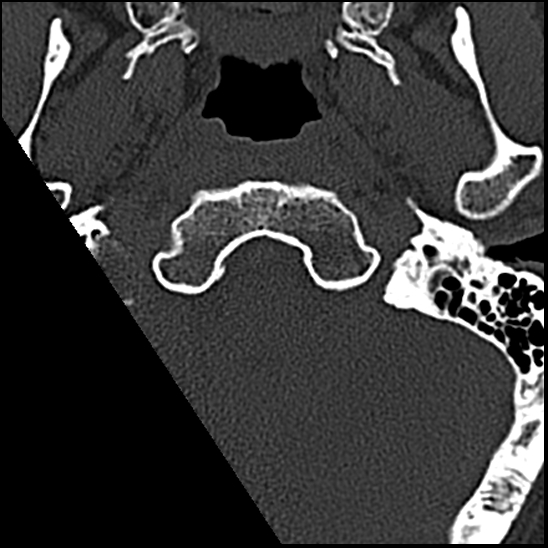 Occipital condyle fracture (type 1) (Radiopaedia 87670-104084 Axial bone window 2).jpg
