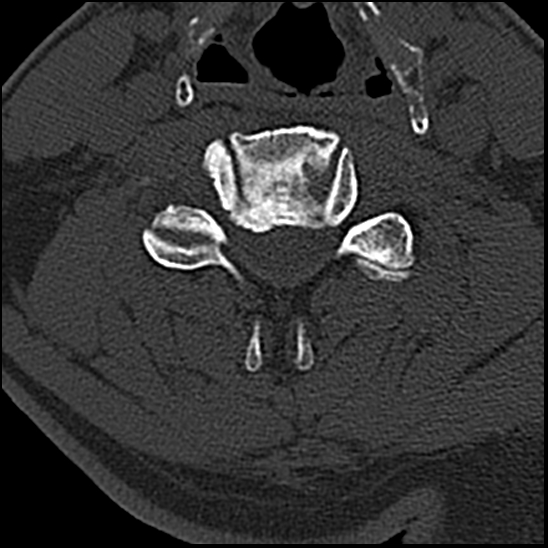 Occipital condyle fracture (type 1) (Radiopaedia 87670-104084 Axial bone window 53).jpg