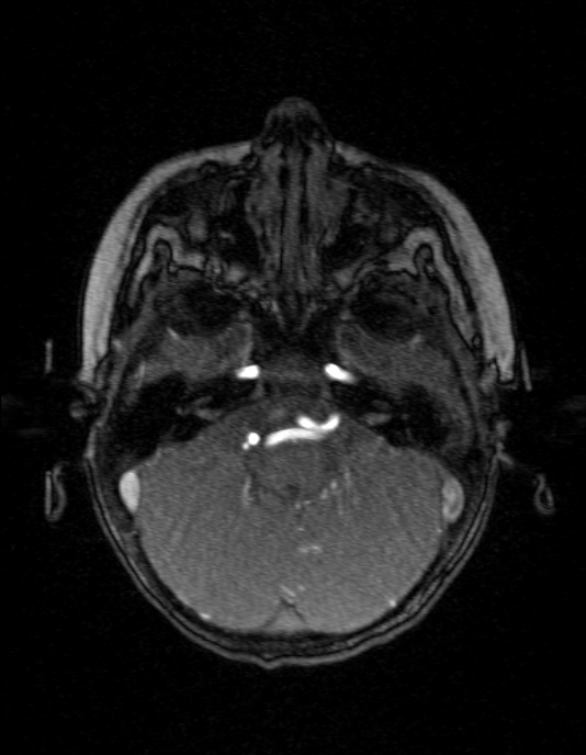 Occipital horn syndrome (Radiopaedia 14255-14129 MRA 34).jpg