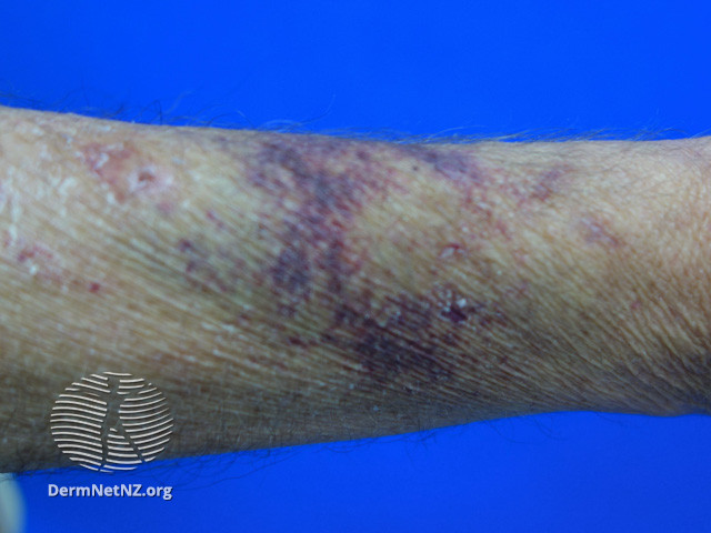 File:Senile purpura (DermNet NZ vascular-senile-purpura-1).jpg