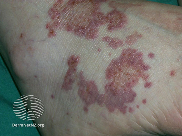 File:Sjogren vasculitis (DermNet NZ immune-sjogren3).jpg