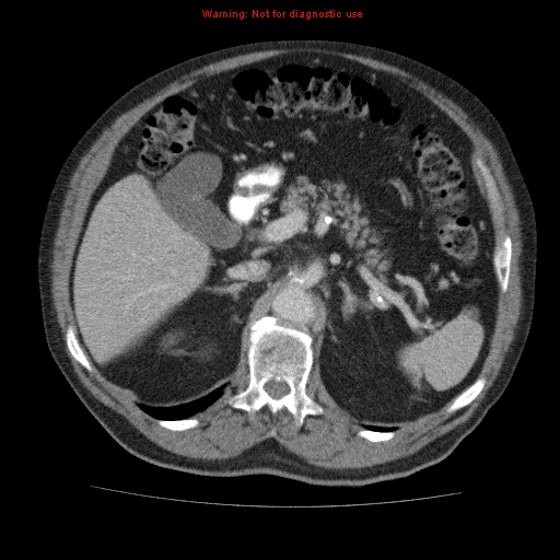 Abdominal aortic aneurysm (Radiopaedia 10122-10660 Axial C+ portal venous phase 22).jpg