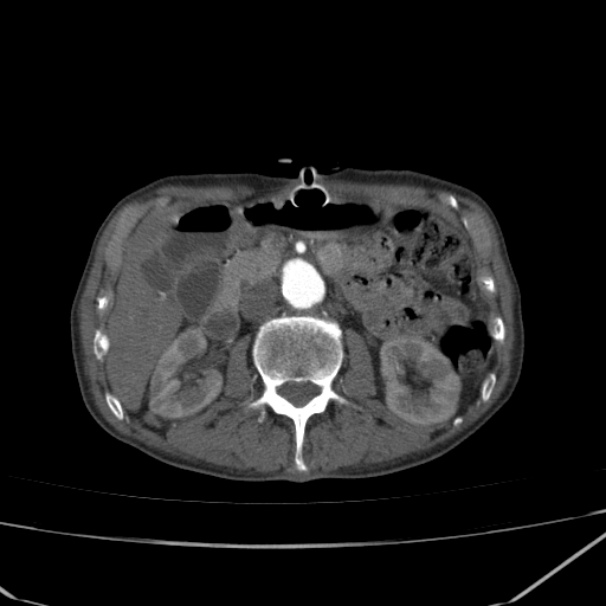 Abdominal aortic aneurysm (Radiopaedia 23703-23856 Axial C+ arterial phase 30).jpg