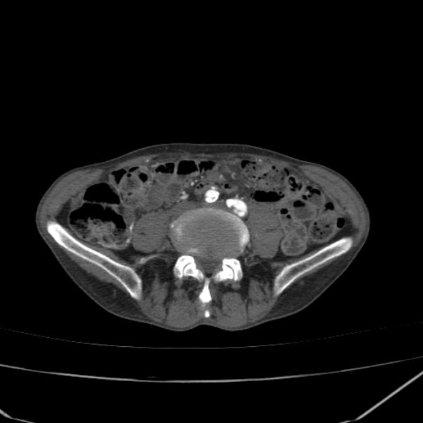 Abdominal aortic aneurysm (Radiopaedia 23703-23856 Axial C+ arterial phase 59).jpg