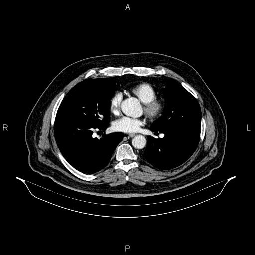 Abdominal aortic aneurysm (Radiopaedia 83094-97462 Axial renal cortical phase 44).jpg