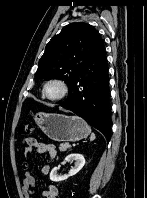 Abdominal aortic aneurysm (Radiopaedia 83094-97462 Sagittal renal cortical phase 90).jpg