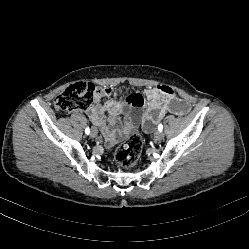 Abdominal aortic aneurysm (Radiopaedia 83581-98689 Axial C+ arterial phase 95).jpg