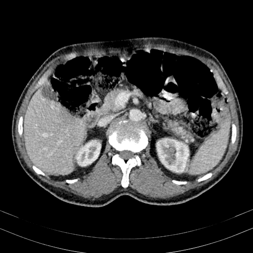 File:Abdominal aortic aneurysm (Radiopaedia 83581-98689 Axial C+ portal venous phase 39).jpg