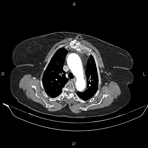 File:Abdominal aortic aneurysm (Radiopaedia 85063-100606 Axial C+ arterial phase 12).jpg