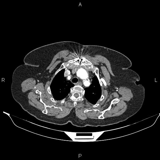 File:Abdominal aortic aneurysm (Radiopaedia 85063-100606 Axial C+ arterial phase 9).jpg