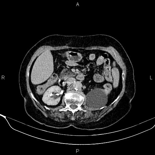 File:Abdominal aortic aneurysm (Radiopaedia 85063-100606 Axial C+ delayed 39).jpg