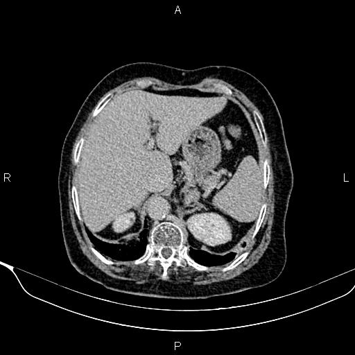 Abdominal aortic aneurysm (Radiopaedia 85063-100606 Axial C+ delayed 9).jpg