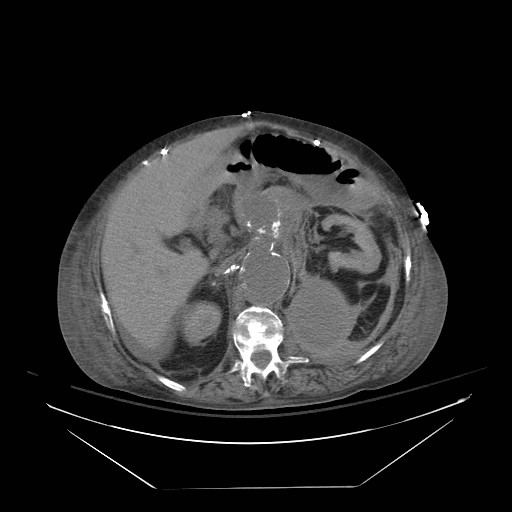 Abdominal aortic aneurysm - impending rupture (Radiopaedia 19233-19247 Axial non-contrast 66).jpg